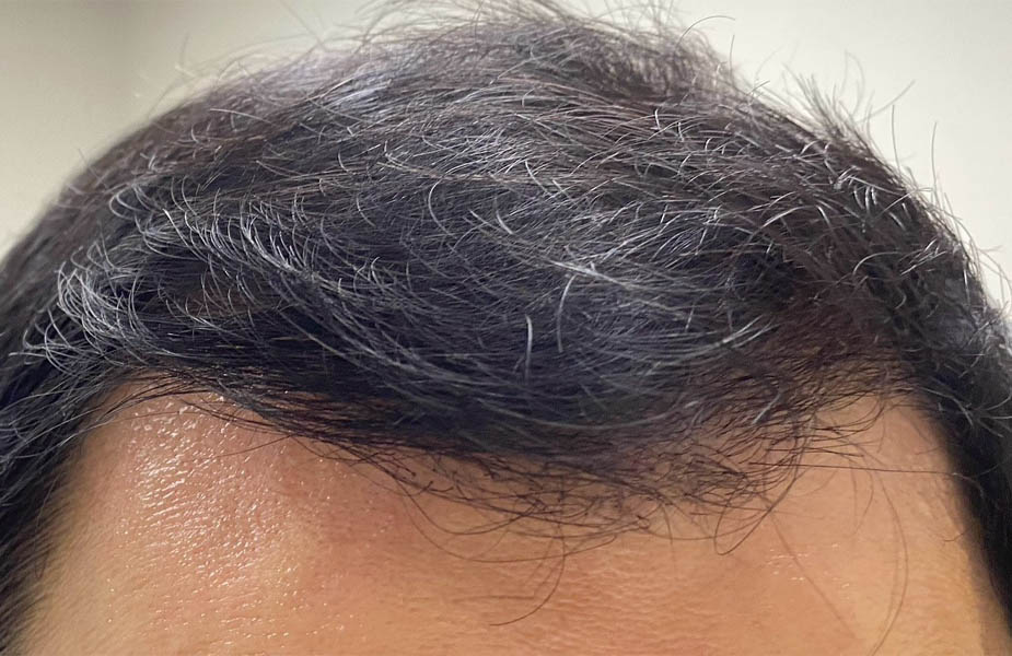 NeoGraft hair transplant — after