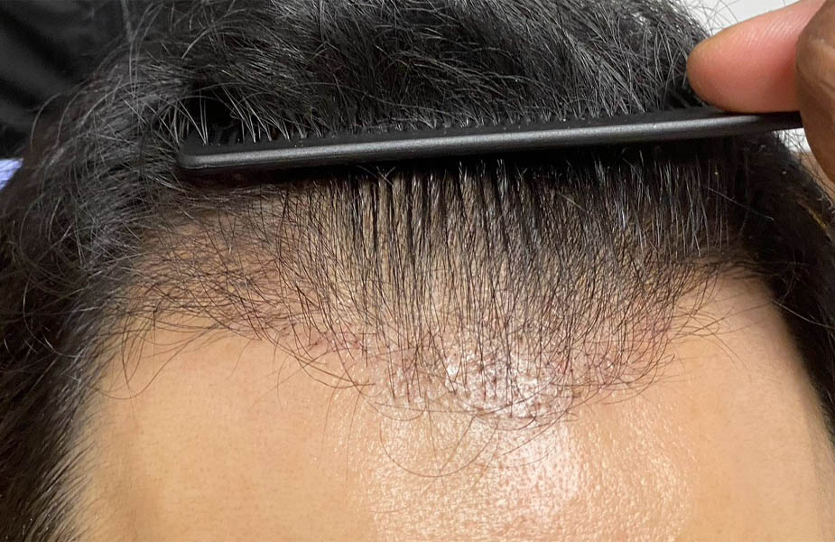 NeoGraft hair transplant — before