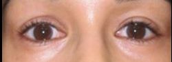 Patient Case #10836 — after lower eyelid blepharoplasty