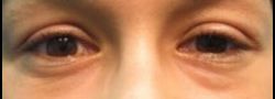 Patient Case #10836 — before lower eyelid blepharoplasty