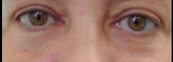 Patient Case #10833 — after lower eyelid blepharoplasty