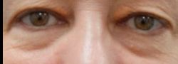 Patient Case #10833 — before lower eyelid blepharoplasty