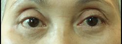 Patient Case #10830 — after lower eyelid blepharoplasty