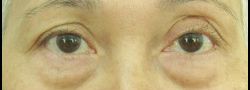 Patient Case #10830 — before lower eyelid blepharoplasty