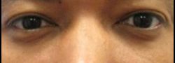 Patient Case #10827 — after lower eyelid blepharoplasty
