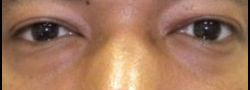 Patient Case #10827 — before lower eyelid blepharoplasty