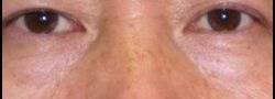 Patient Case #10824 — after lower eyelid blepharoplasty