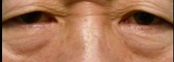 Patient Case #10824 — before lower eyelid blepharoplasty