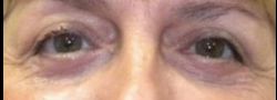Patient Case #10821 — after lower eyelid blepharoplasty