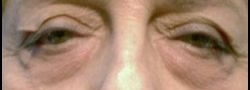 Patient Case #10821 — before lower eyelid blepharoplasty