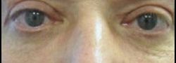 Patient Case #10818 — after lower eyelid blepharoplasty