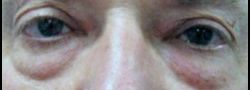 Patient Case #10818 — before lower eyelid blepharoplasty
