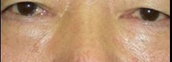 Patient Case #10815 — after lower eyelid blepharoplasty