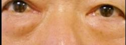 Patient Case #10815 — before lower eyelid blepharoplasty