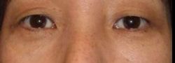 Patient Case #10812 — after lower eyelid blepharoplasty