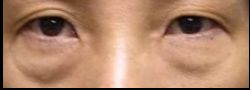 Patient Case #10812 — before lower eyelid blepharoplasty