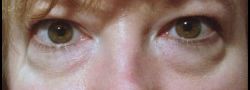 Patient Case #10807 — before lower eyelid blepharoplasty