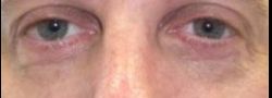 Patient Case #10803 — after lower eyelid blepharoplasty