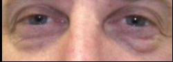 Patient Case #10803 — before lower eyelid blepharoplasty