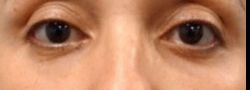 Patient Case #10799 — after lower eyelid blepharoplasty