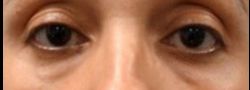 Patient Case #10799 — before lower eyelid blepharoplasty