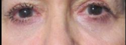 Patient Case #10796 — after lower eyelid blepharoplasty