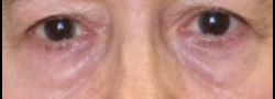 Patient Case #10796 — before lower eyelid blepharoplasty