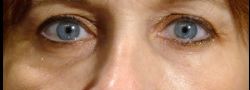 Patient Case #10793 — after lower eyelid blepharoplasty