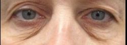Patient Case #10793 — before lower eyelid blepharoplasty