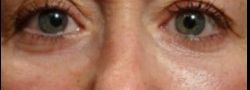 Patient Case #10790 — after lower eyelid blepharoplasty