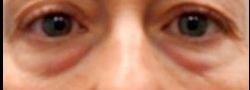 Patient Case #10790 — before lower eyelid blepharoplasty