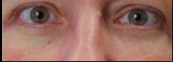 Patient Case #10787 — after lower eyelid blepharoplasty