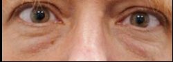 Patient Case #10787 — before lower eyelid blepharoplasty