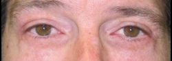 Patient Case #10783 — after lower eyelid blepharoplasty