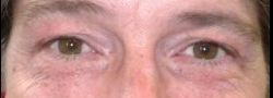 Patient Case #10783 — before lower eyelid blepharoplasty