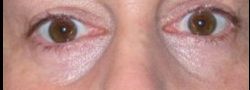 Patient Case #10780 — after lower eyelid blepharoplasty