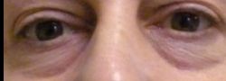 Patient Case #10780 — before lower eyelid blepharoplasty