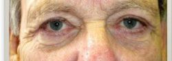 Patient Case #10777 — after lower eyelid blepharoplasty