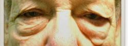 Patient Case #10777 — before lower eyelid blepharoplasty