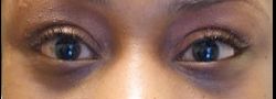 Patient Case #10774 — after lower eyelid blepharoplasty
