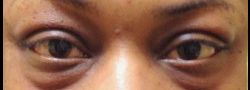 Patient Case #10774 — before lower eyelid blepharoplasty