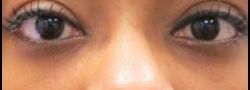 Patient Case #10771 — after lower eyelid blepharoplasty