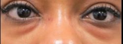 Patient Case #10771 — before lower eyelid blepharoplasty