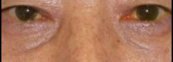 Patient Case #160 — after lower eyelid blepharoplasty