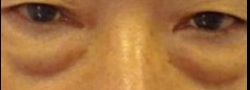 Patient Case #160 — before lower eyelid blepharoplasty