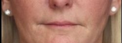 Patient Case #10845 — after