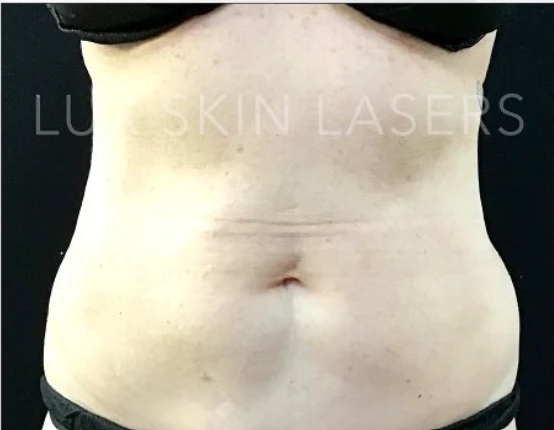 CoolSculpting B&A — after
