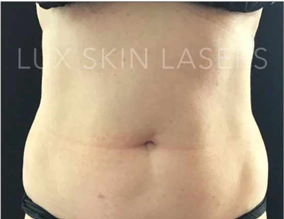CoolSculpting B&A — before