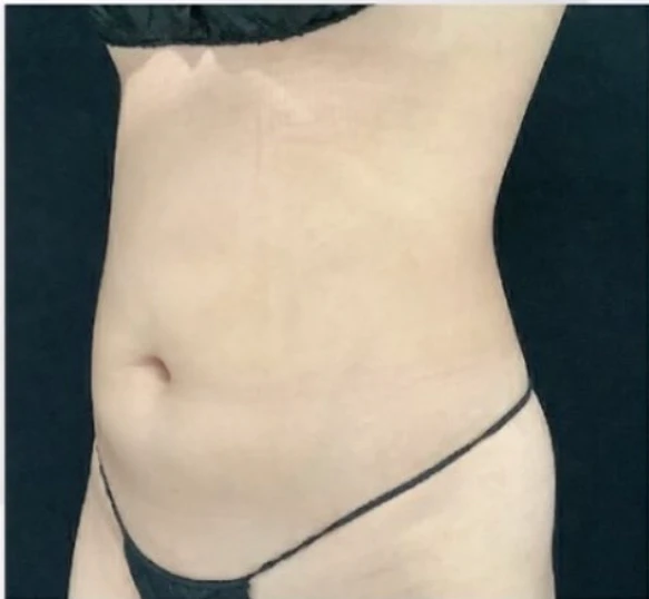 CoolSculpting B&A — after