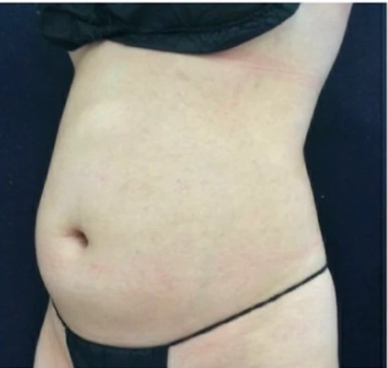 CoolSculpting B&A — before